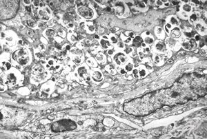 F,40y. | granular cell tumor - larynx